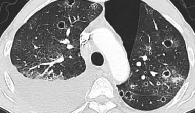 Cause of lung metastasis