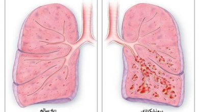 برونشکتازی چیست؟